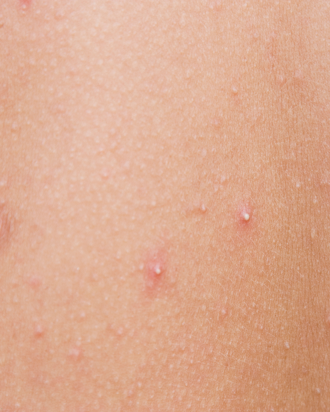 Hvítir fílapenslar