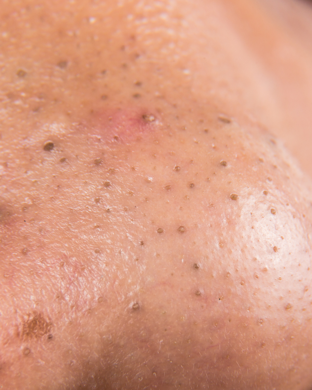 Svartir fílapenslar