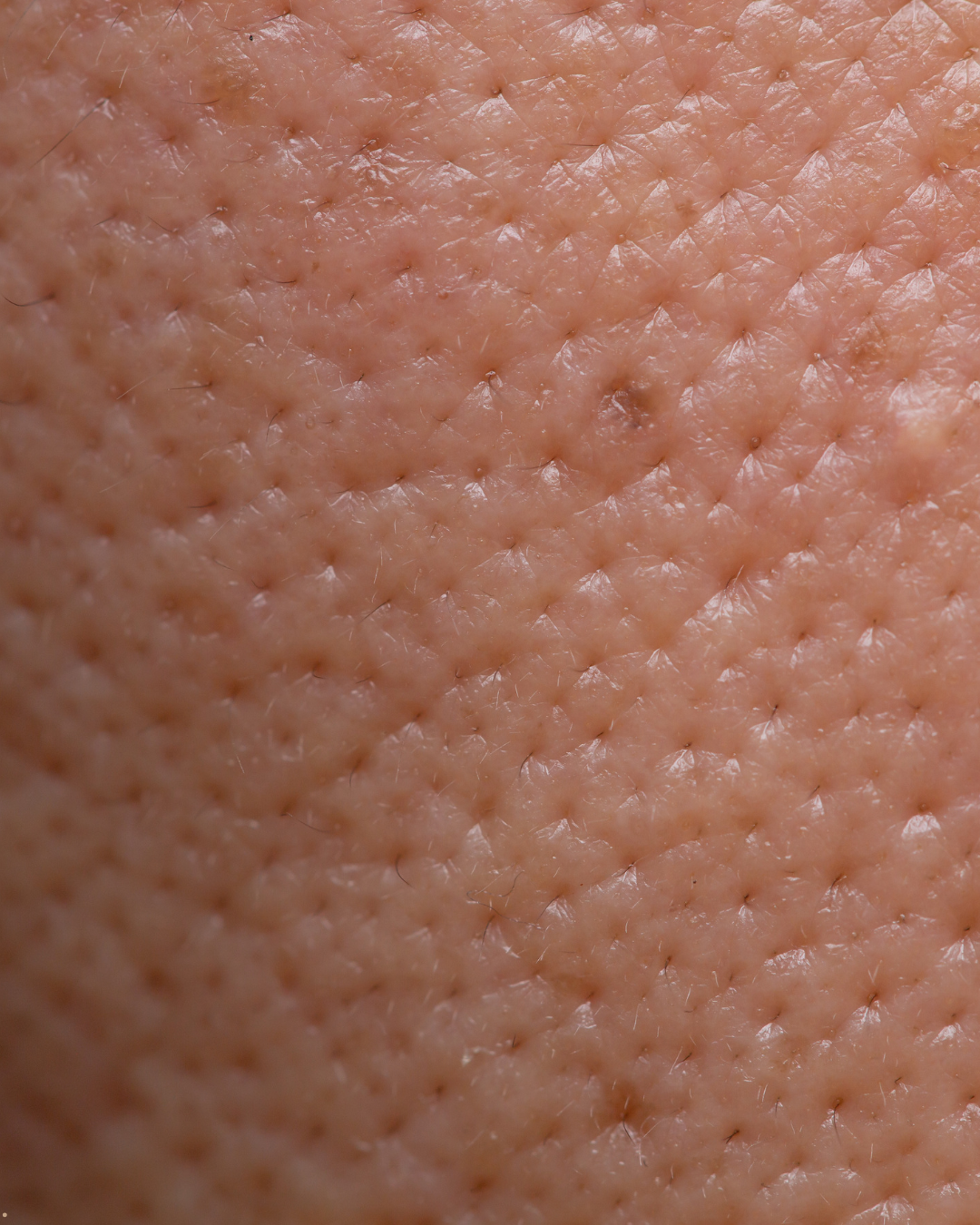 Stíflaðar svitaholur