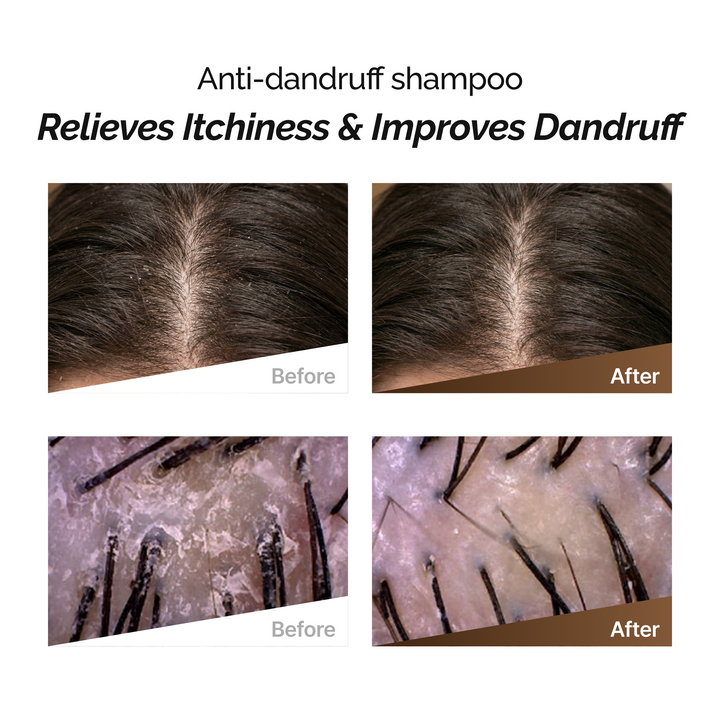 ROOTONIX Anti - Dandruff Shampoo 500ml