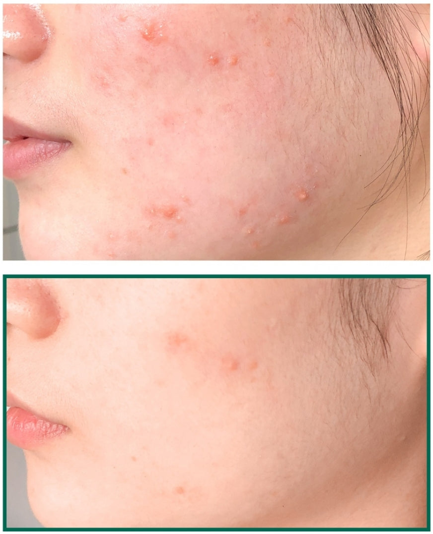 Some By Mi AHA/BHA/PHA 30 Days Miracle Acne Clear Foam 100ml