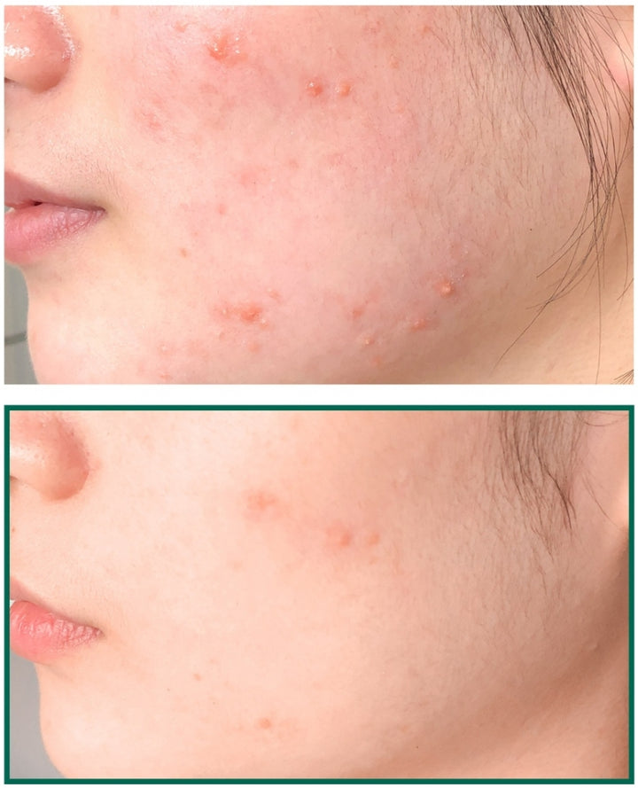 Some By Mi AHA/BHA/PHA 30 Days Miracle Acne Clear Foam 100ml